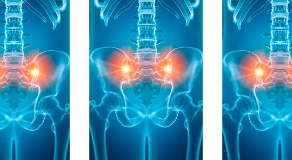 Three x-ray style images of the lower spine and pelvis, with the sacroiliac joints glowing orange.